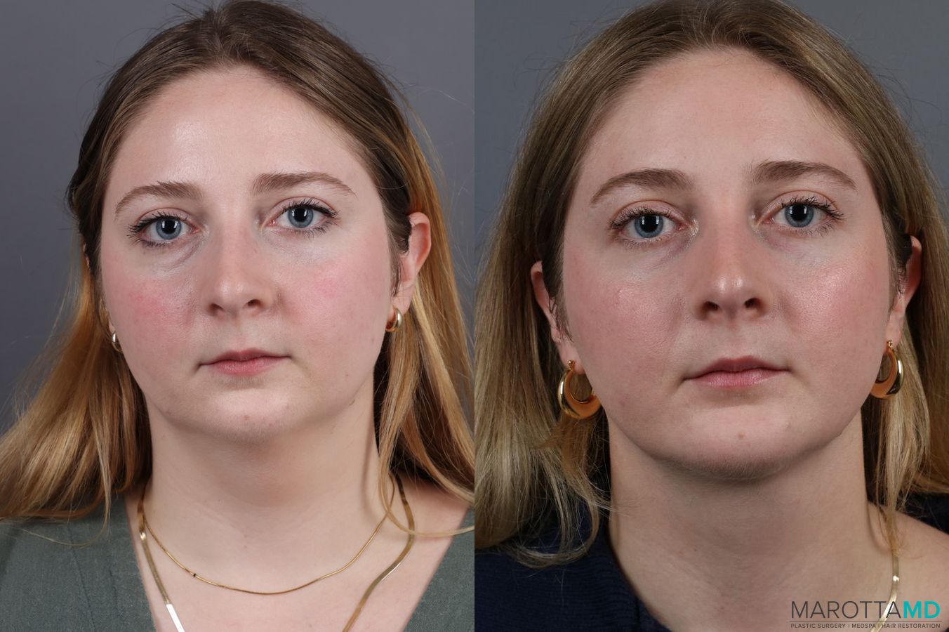 Before and after Liposuction of the Neck case 7031