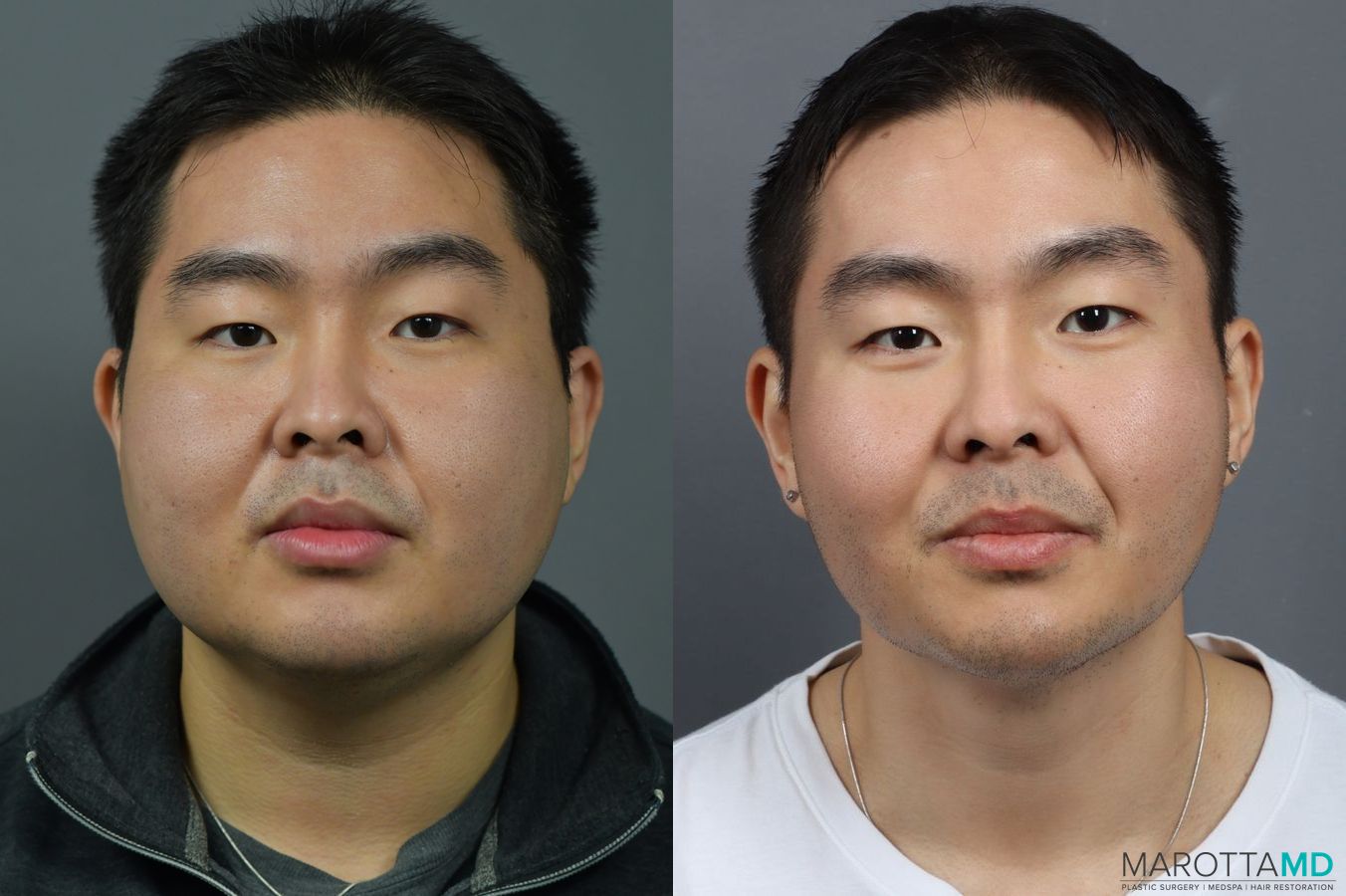 Before and after Liposuction of the Neck case 7041