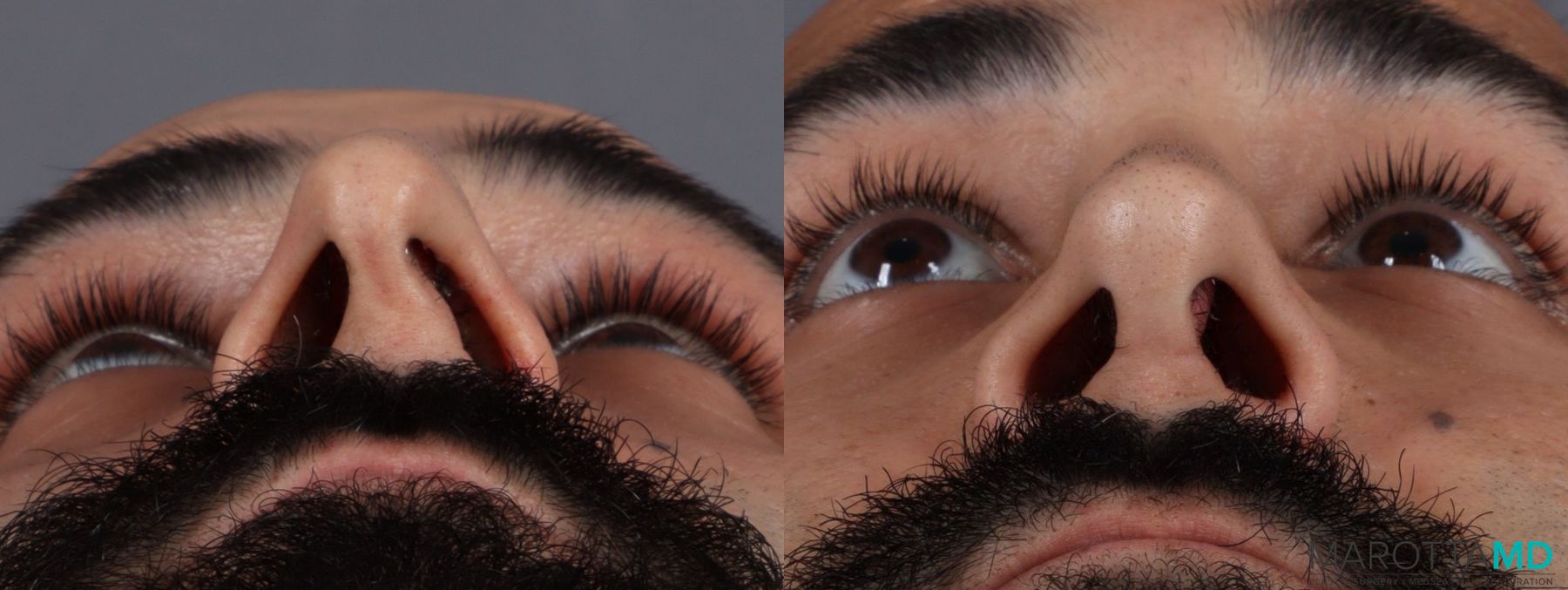 Before and after Male Rhinoplasty case 7261 - Angle 6