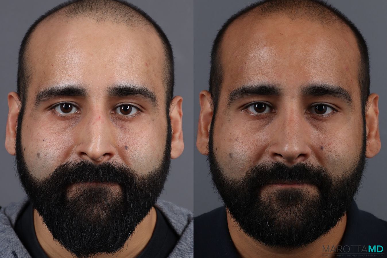 Before and after Male Rhinoplasty case 7261