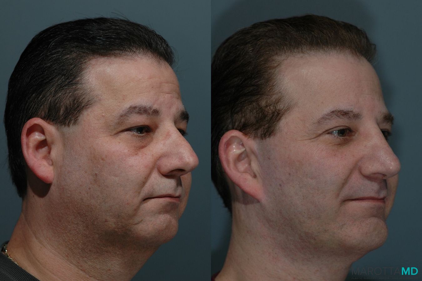 Before and after Male Rhinoplasty case 7074 - Angle 2