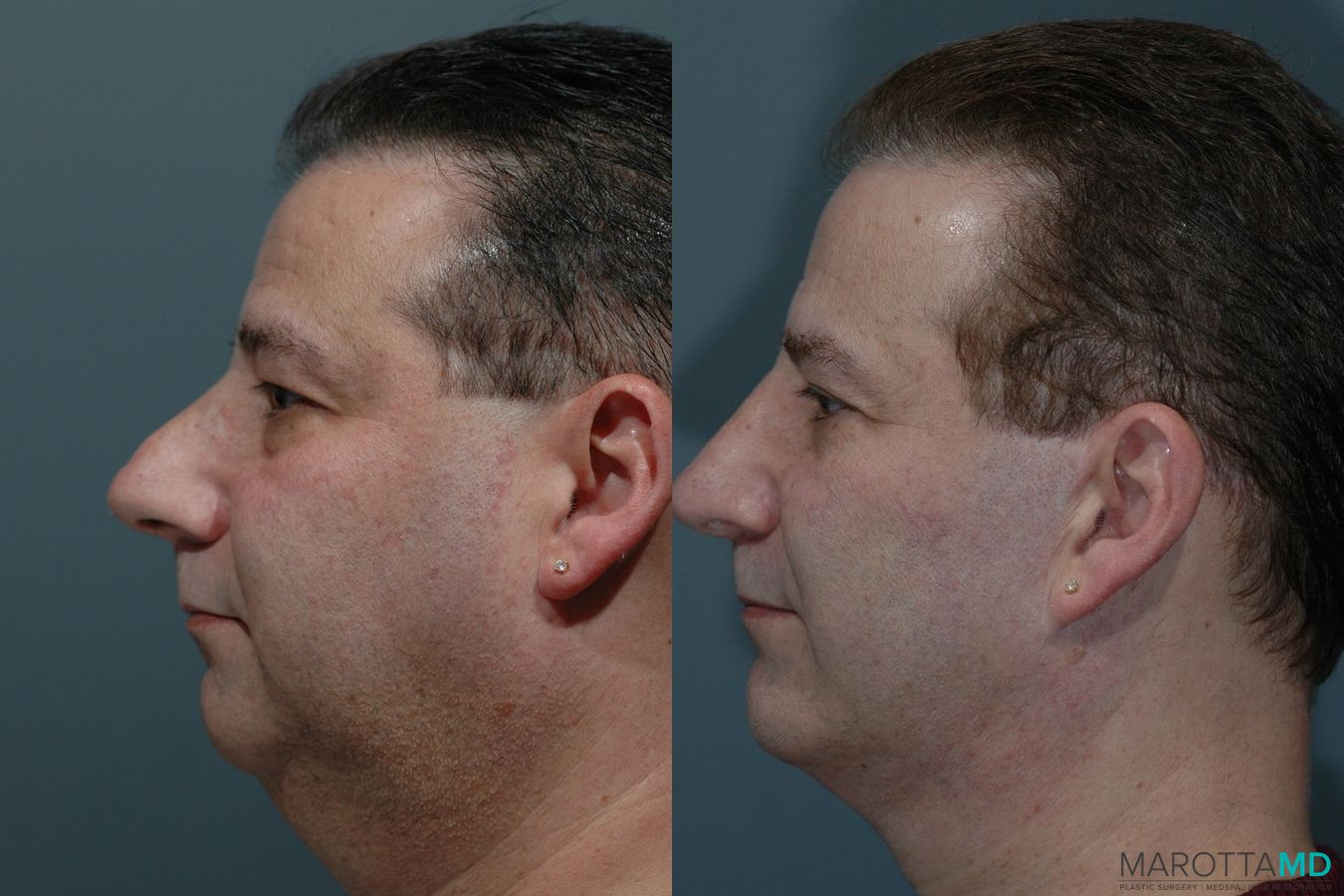 Before and after Male Rhinoplasty case 7074 - Angle 5