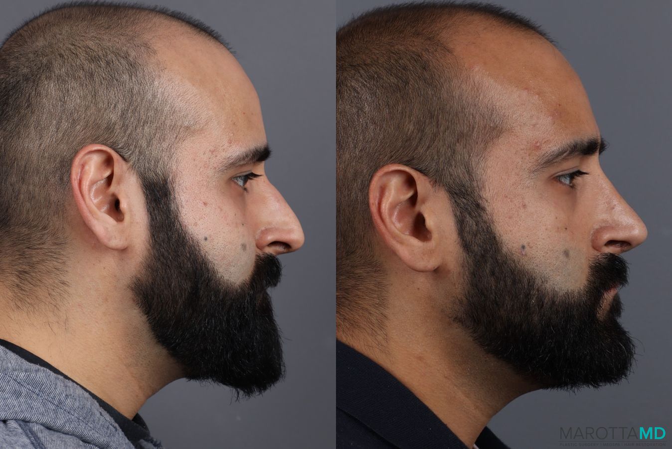 Before and after Male Rhinoplasty case 7261 - Angle 3