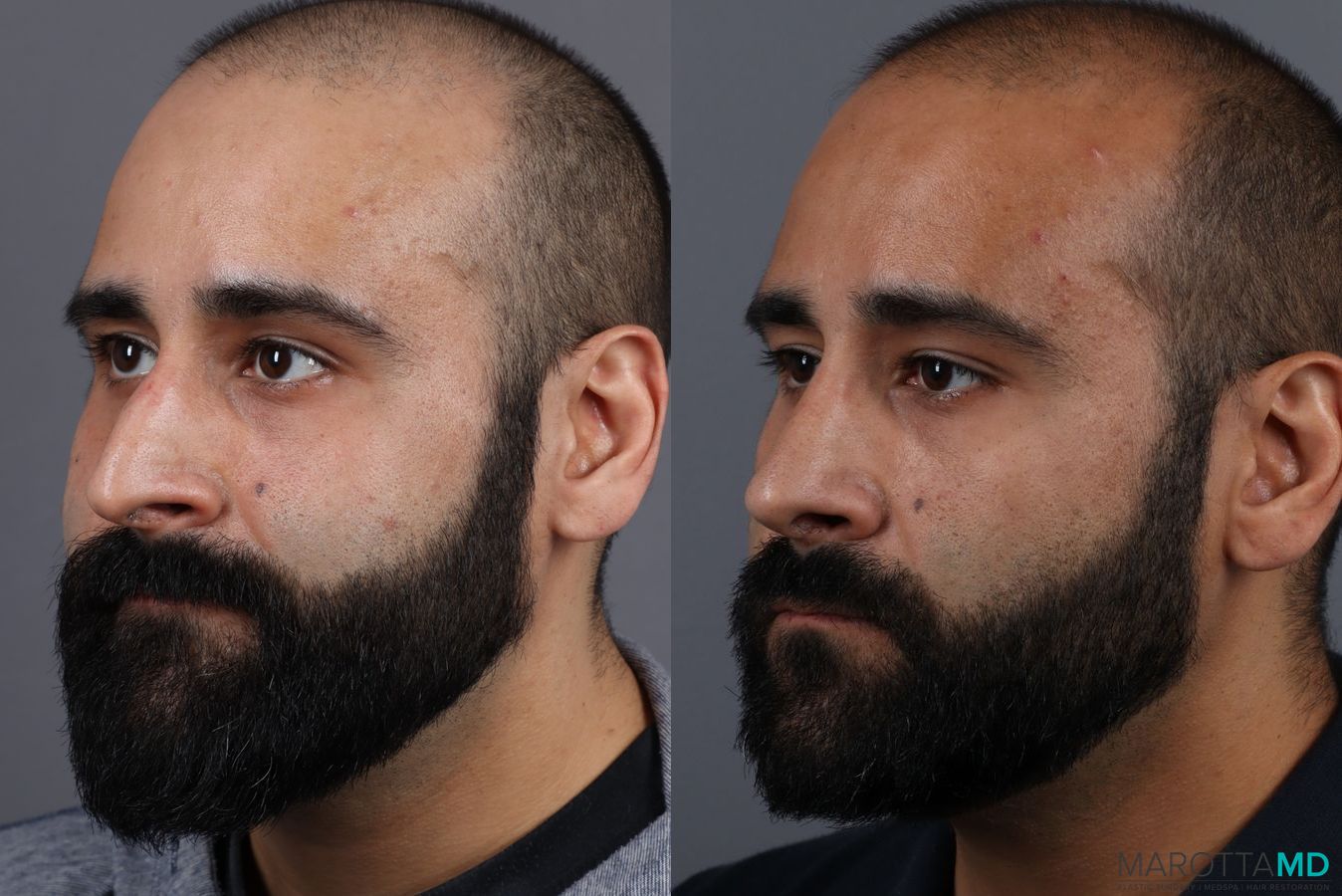 Before and after Male Rhinoplasty case 7261 - Angle 4