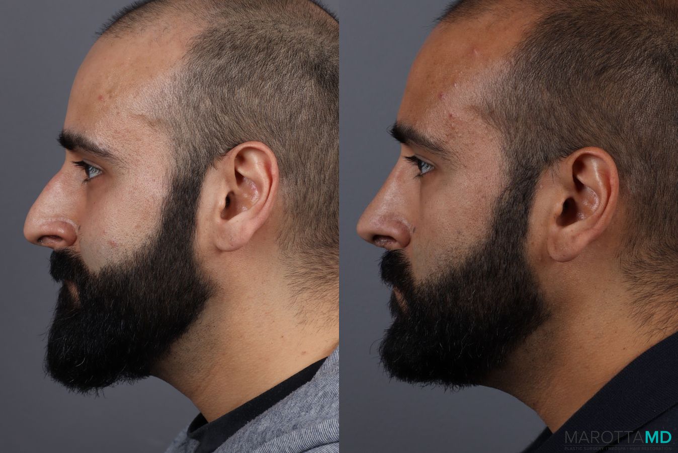 Before and after Male Rhinoplasty case 7261 - Angle 2
