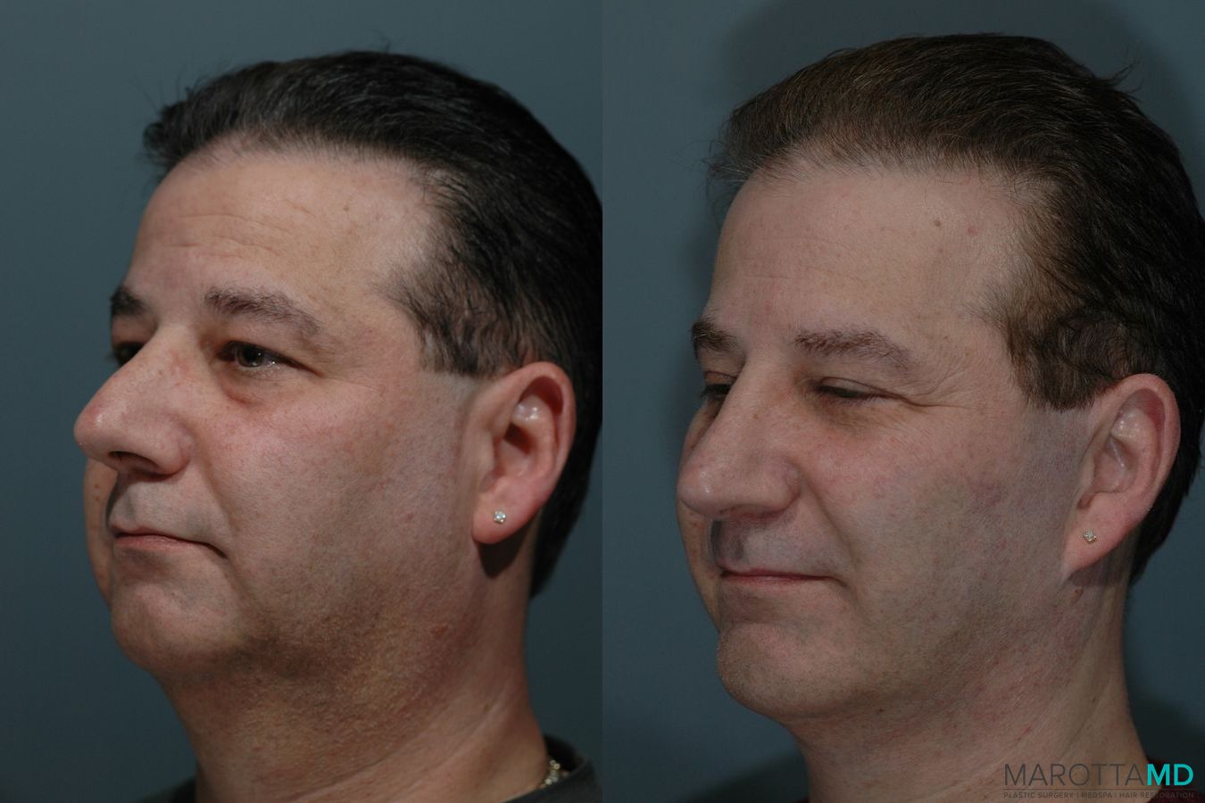 Before and after Male Rhinoplasty case 7074 - Angle 4