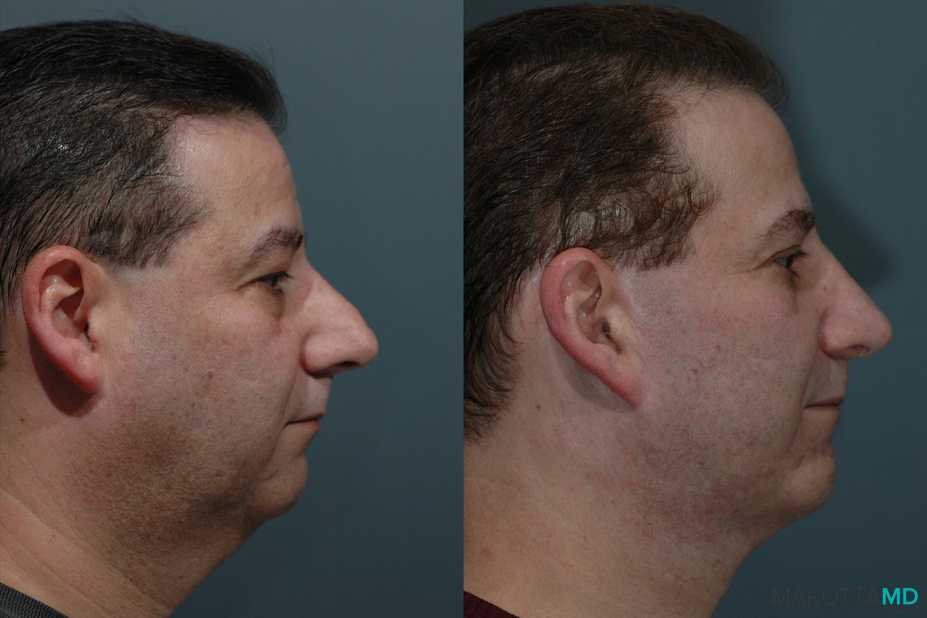 Before and after Male Rhinoplasty case 7074 - Angle 3