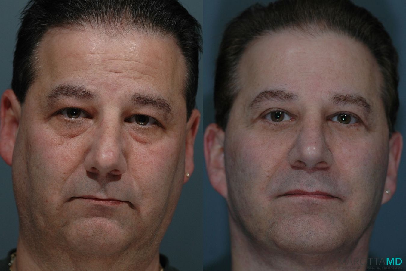 Before and after Male Rhinoplasty case 7074