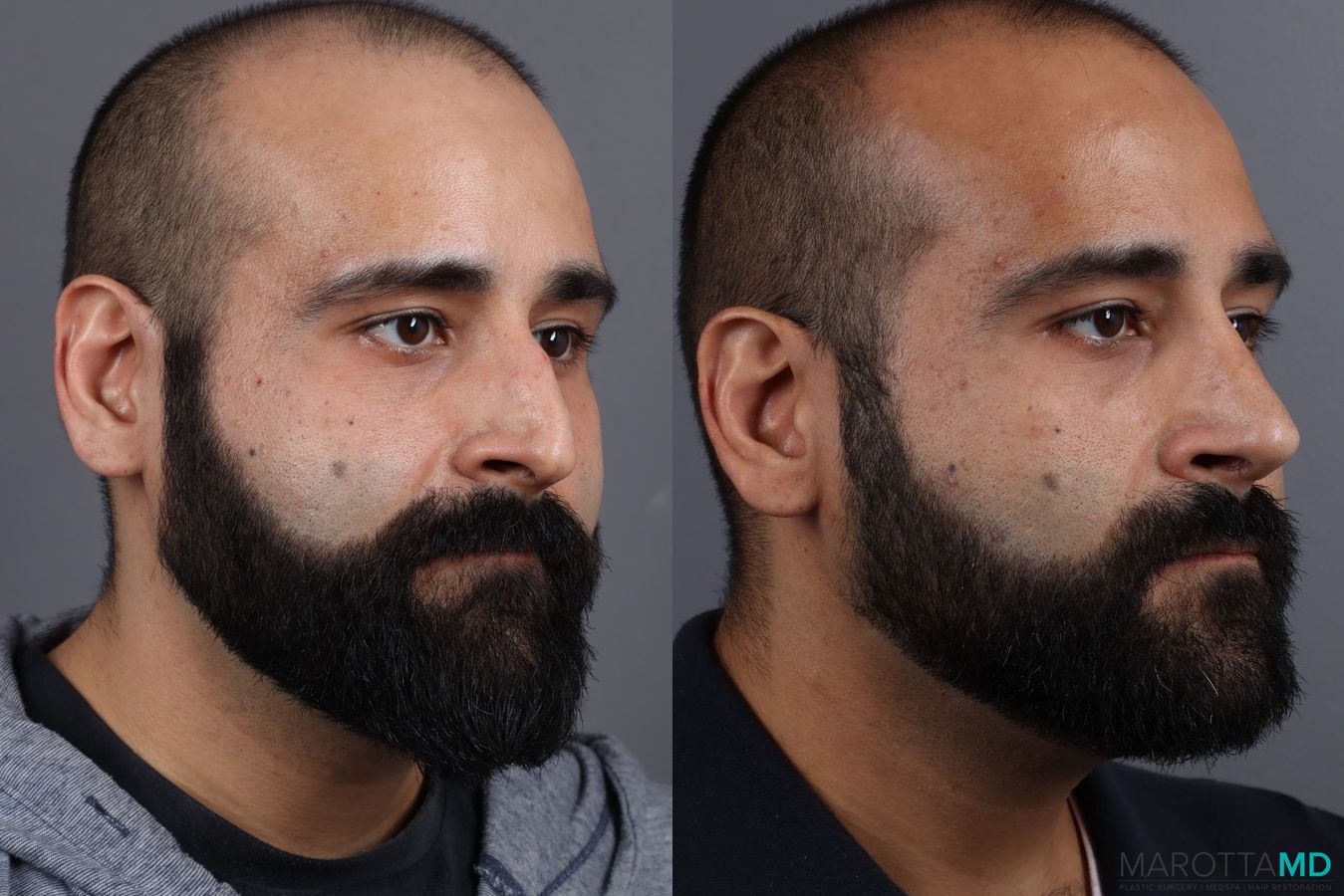 Before and after Male Rhinoplasty case 7261 - Angle 5