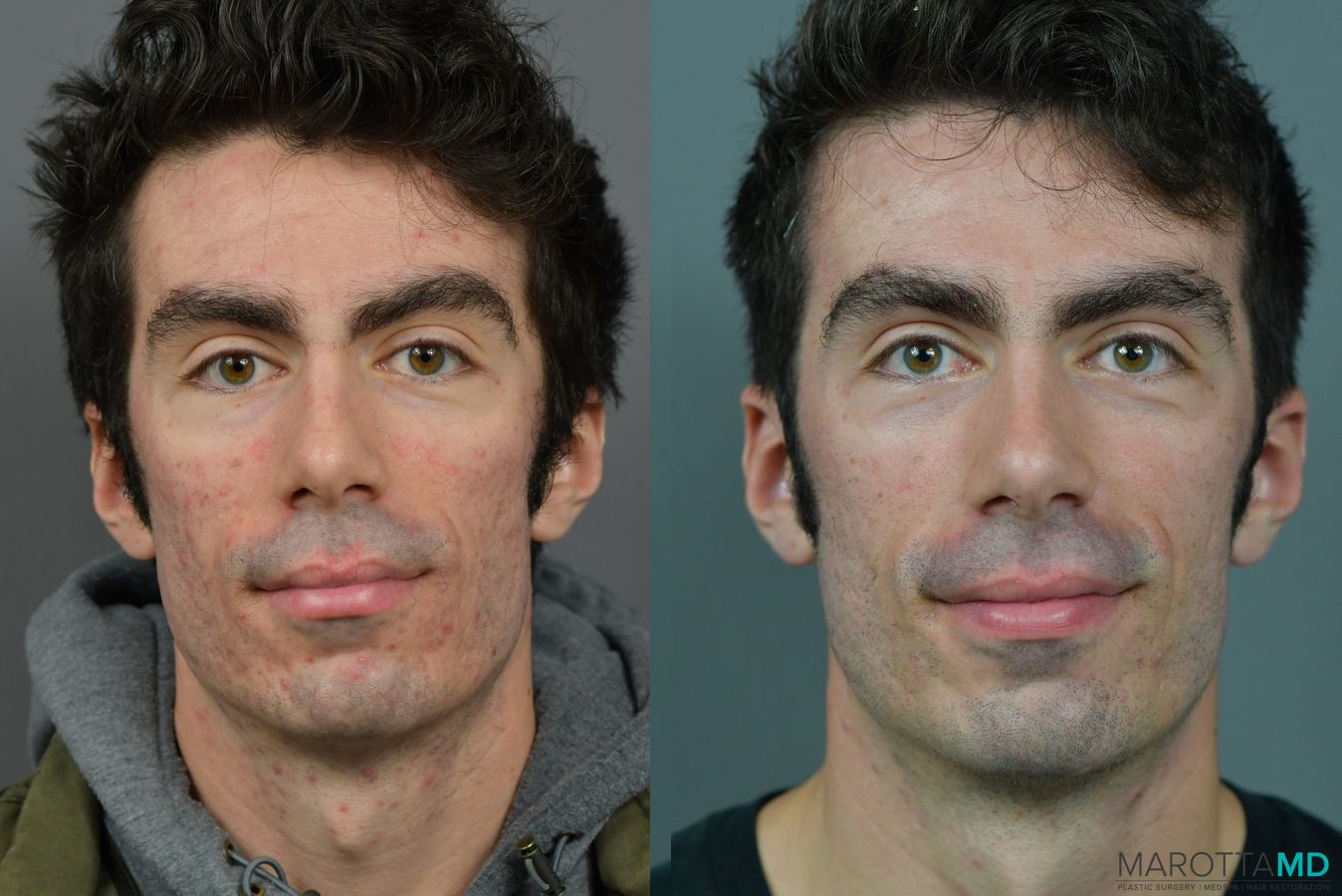 Before and after Microneedling case 7237