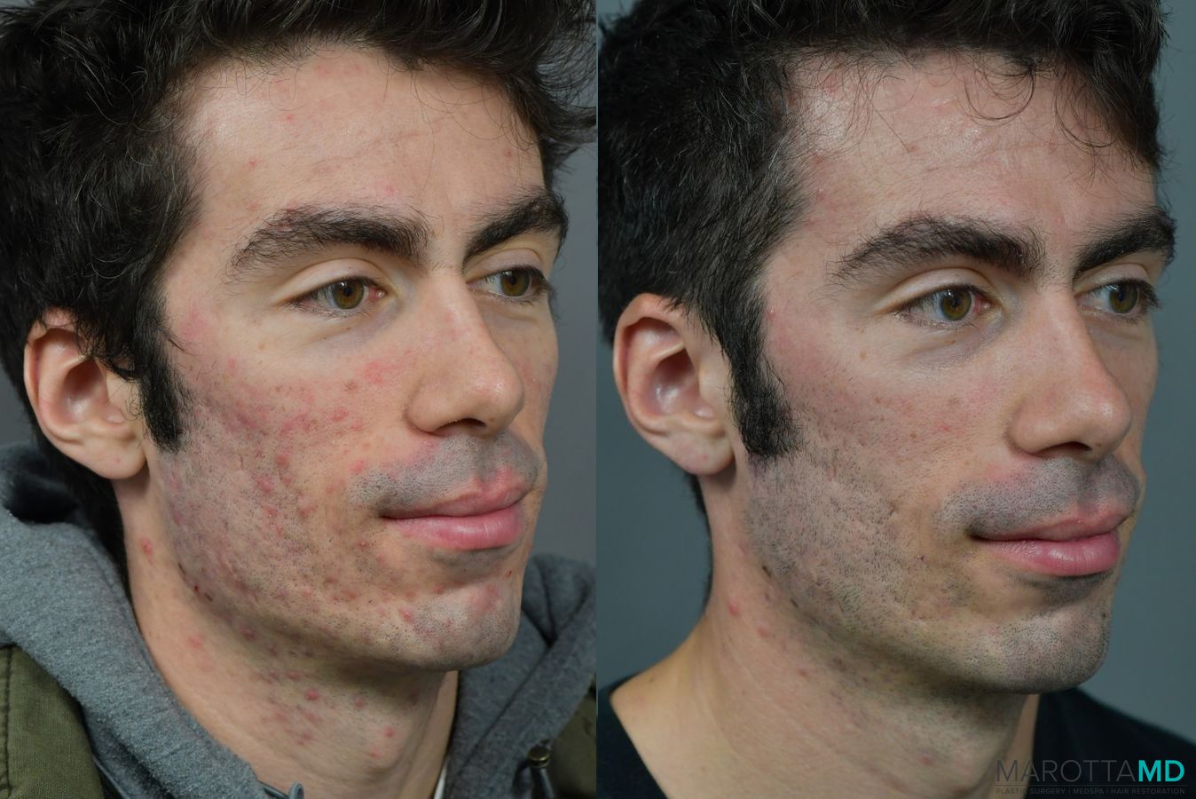 Before and after Microneedling case 7237 - Angle 3