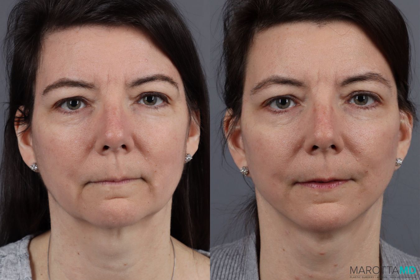 Before and after Mini Facelift case 13003