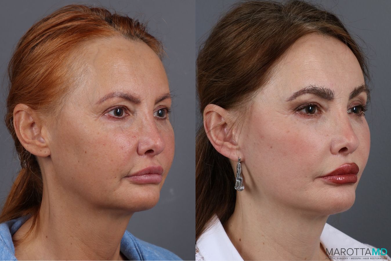 Before and after Mini Facelift case 7058 - Angle 2
