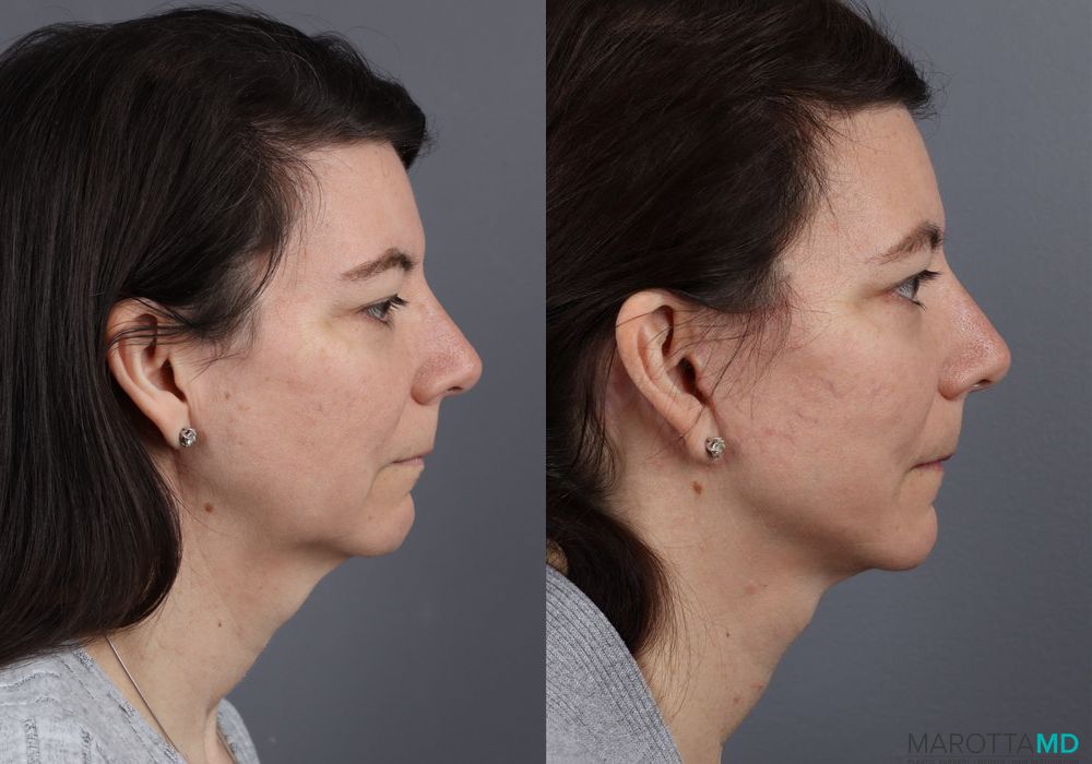 Mini Facelift - Case 238