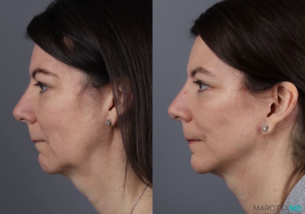 Mini Facelift - Thumbnail 4