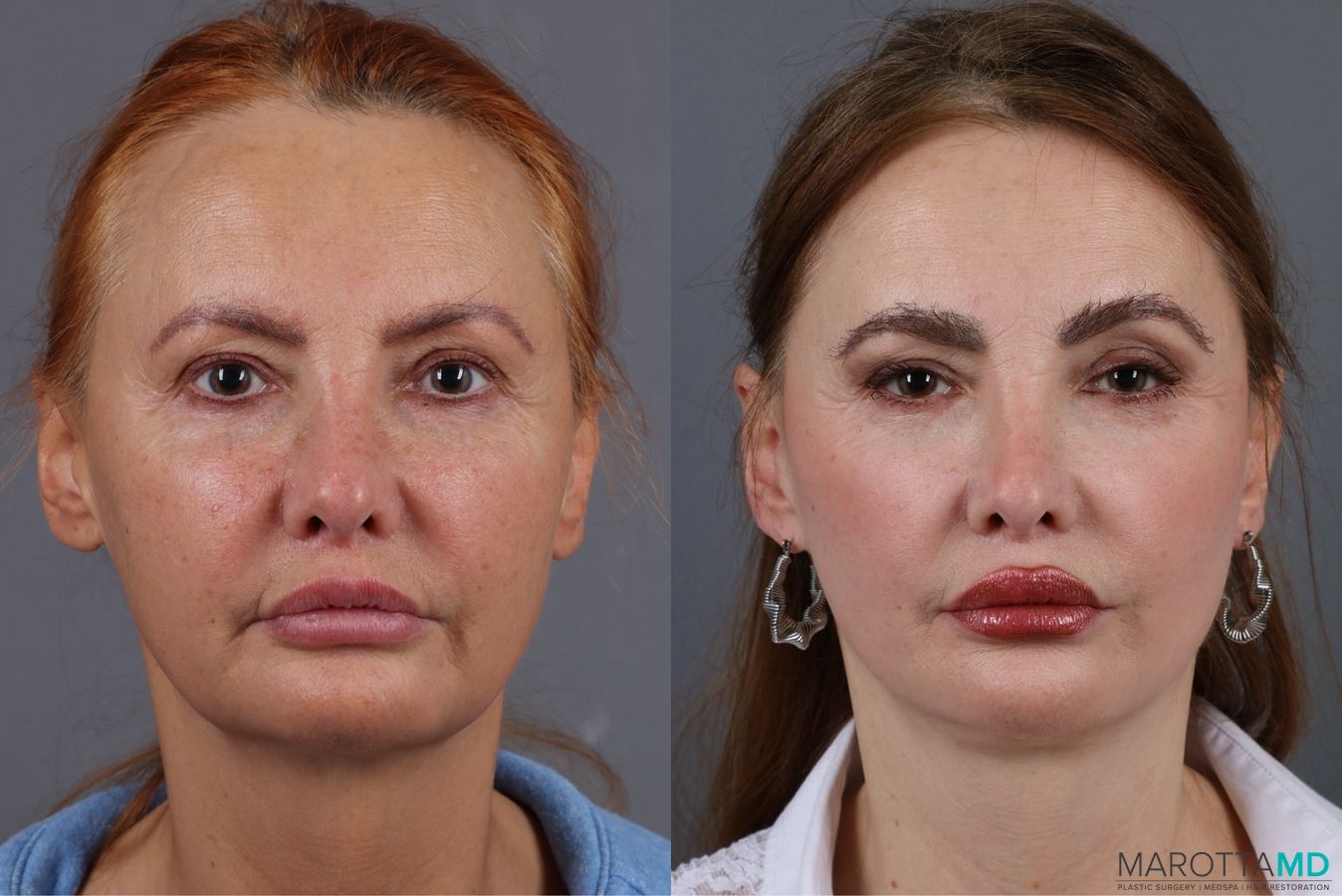 Before and after Mini Facelift case 7058
