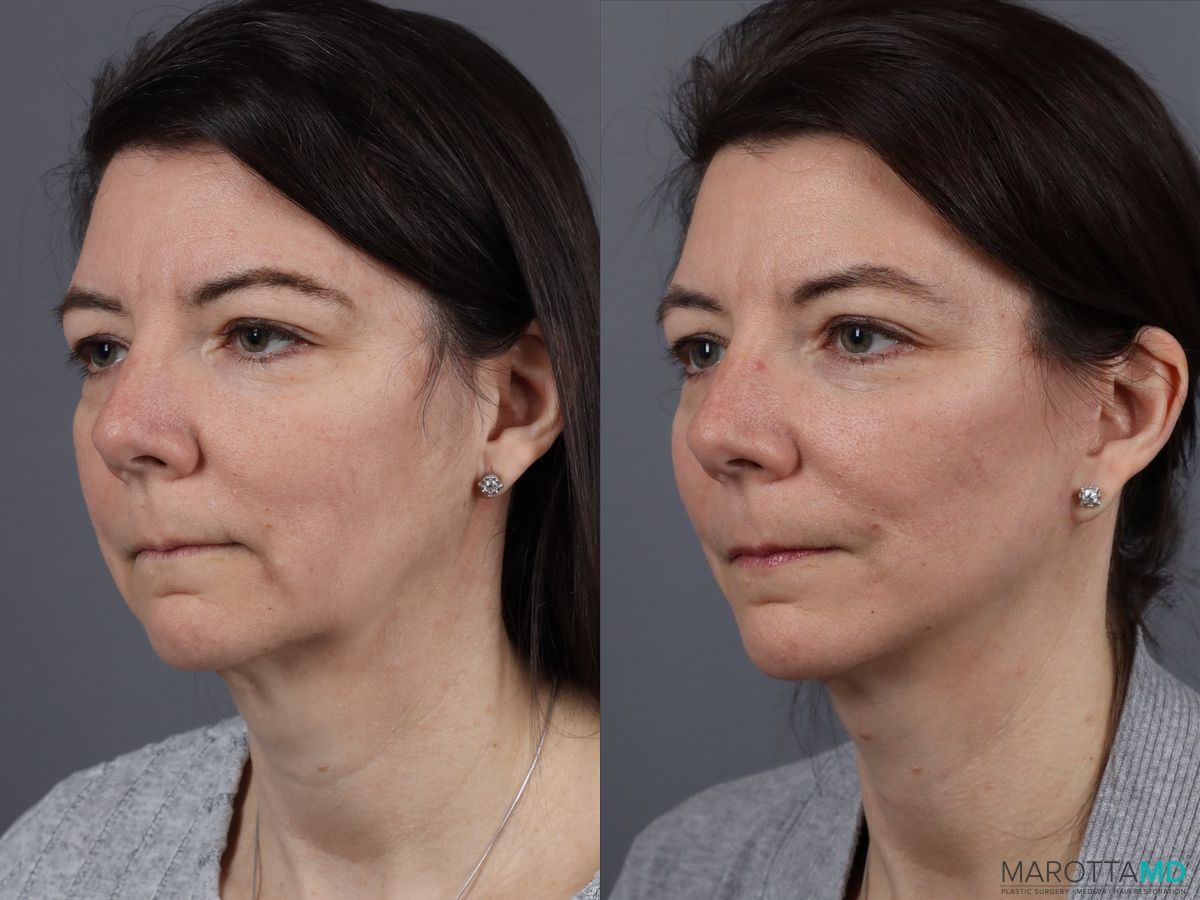 Before and after Mini Facelift case 13003 - Angle 4