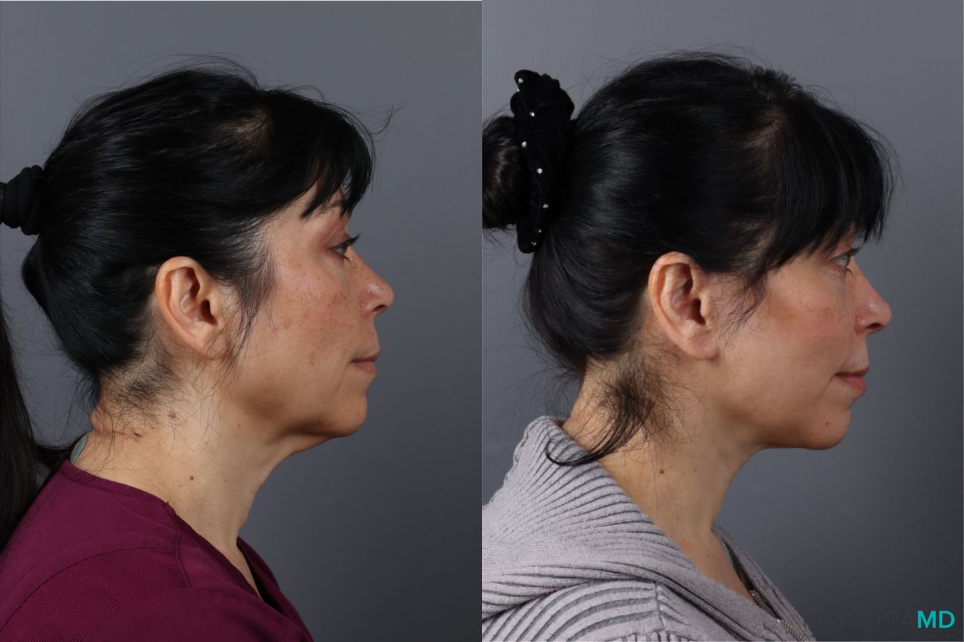 Before and after Laser Skin Resurfacing case 43162 - Angle 3
