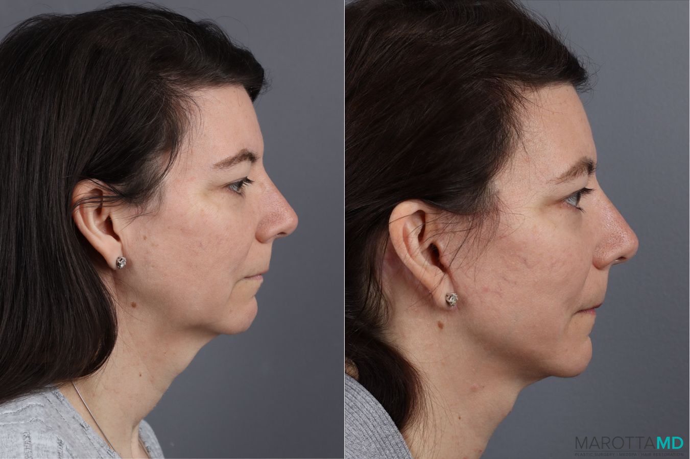 Before and after Mini Facelift case 13003 - Angle 3
