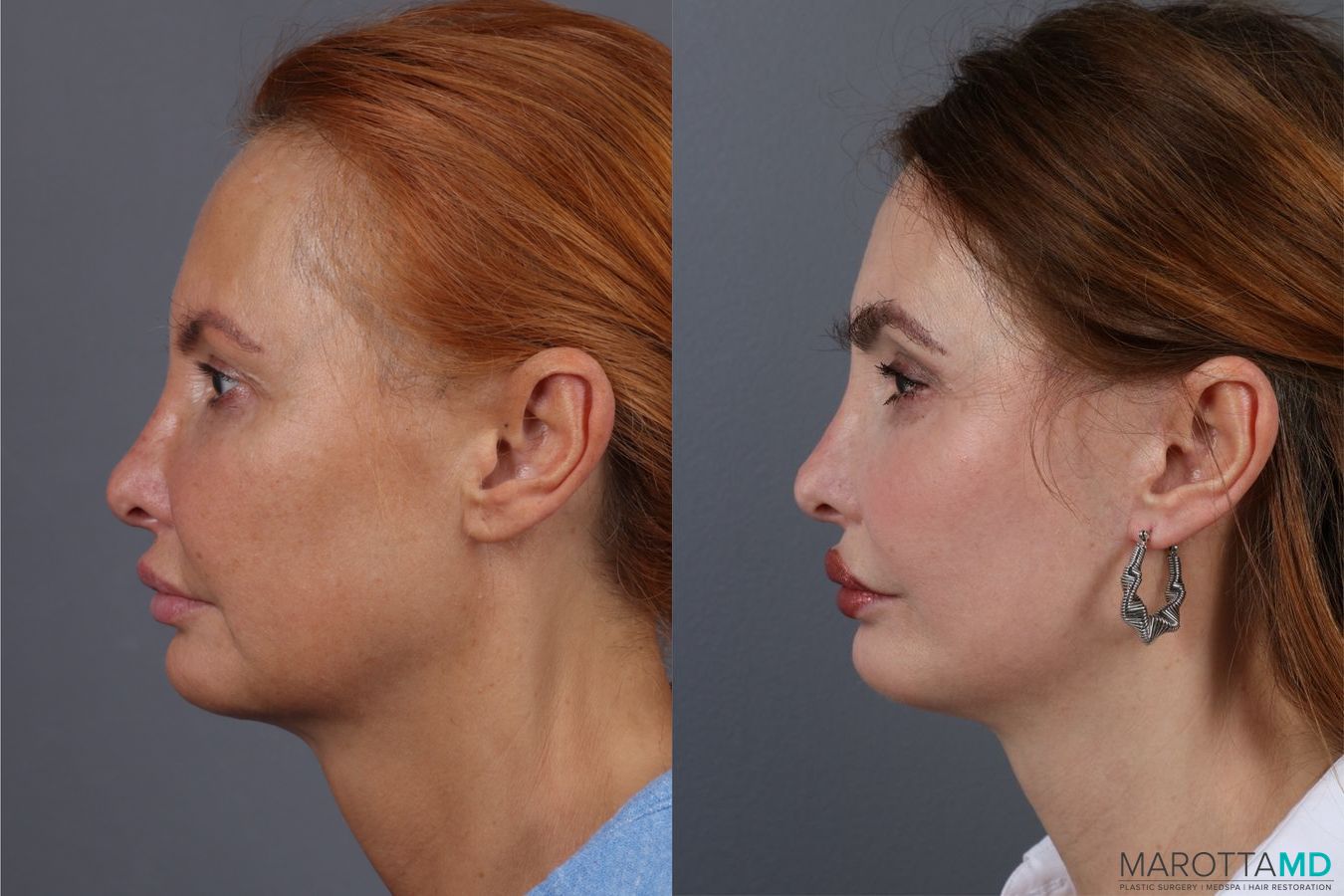 Before and after Mini Facelift case 7058 - Angle 5