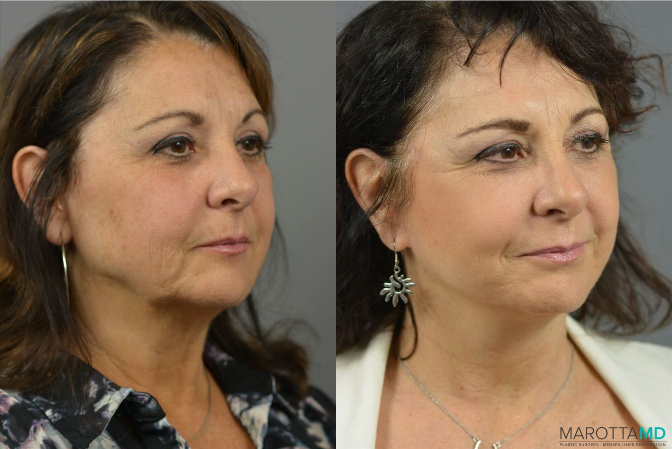 Before and after Laser Skin Resurfacing case 41931 - Angle 2