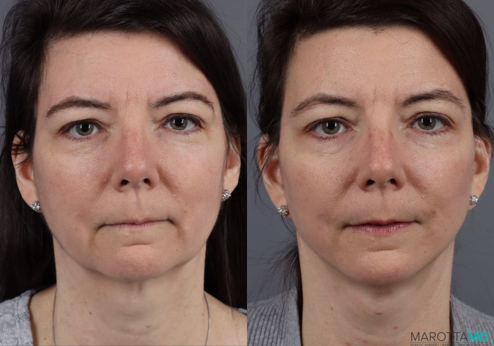 Mini Facelift - Thumbnail 2