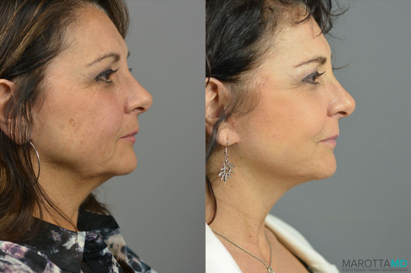 Before and after Laser Skin Resurfacing case 41931 - Angle 3