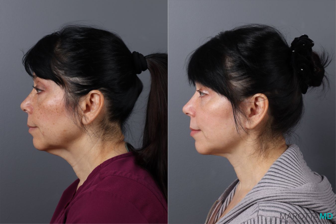 Before and after Laser Skin Resurfacing case 43162 - Angle 5