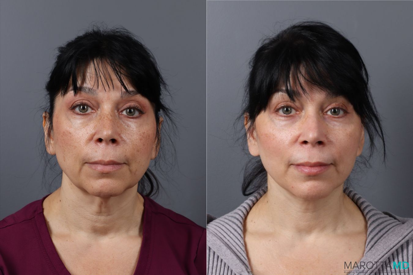 Before and after Laser Skin Resurfacing case 43162