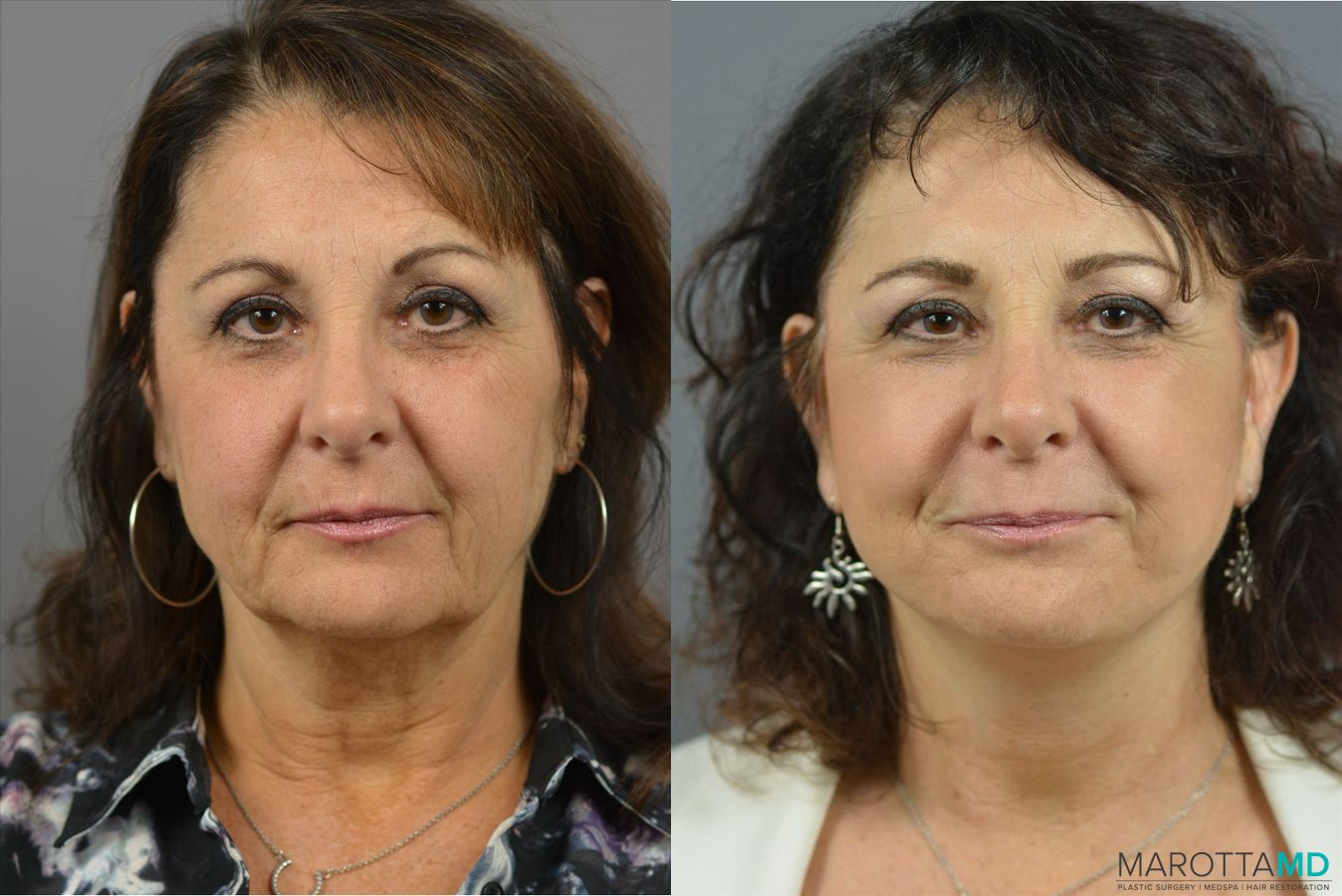 Before and after Laser Skin Resurfacing case 41931