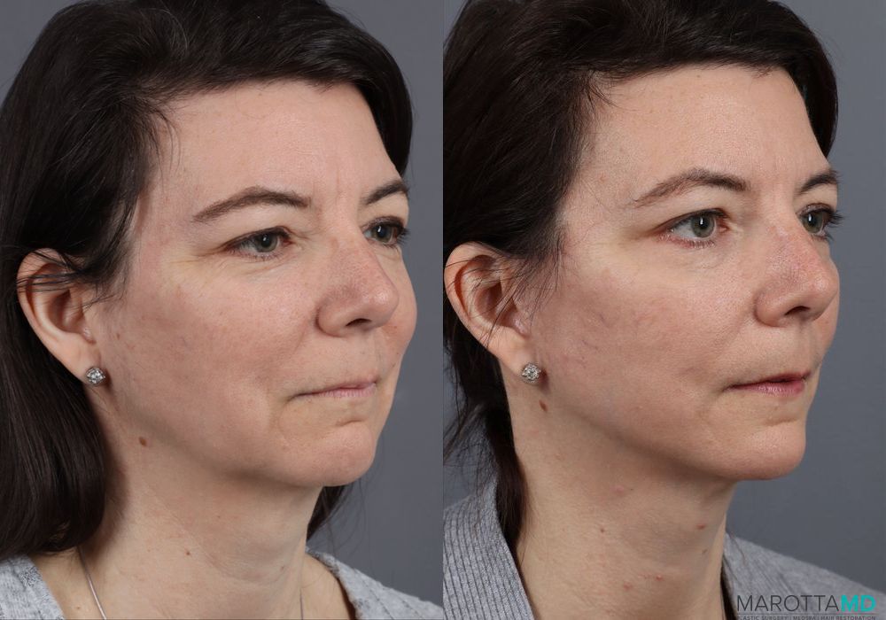 Mini Facelift - Thumbnail 5