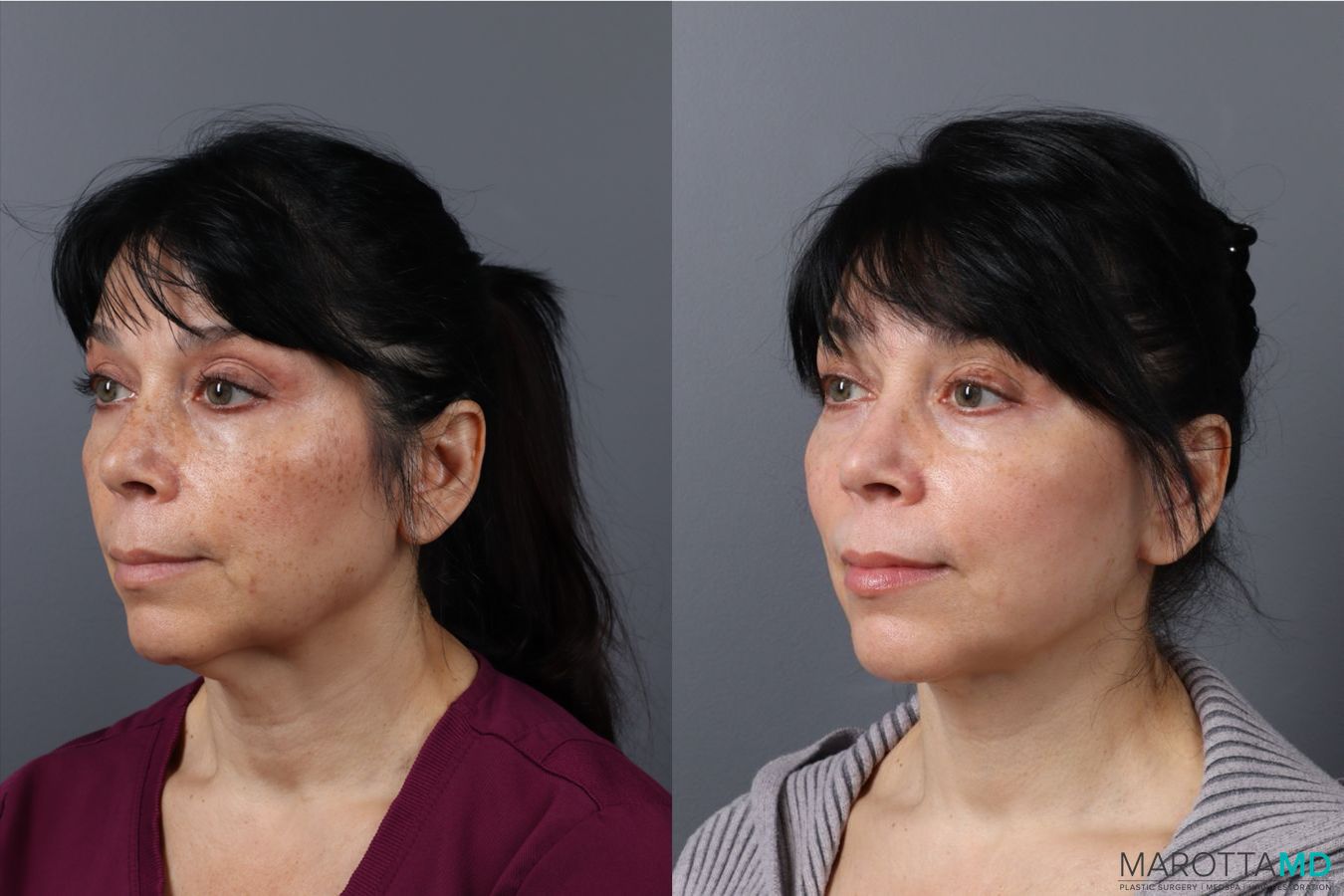 Before and after Laser Skin Resurfacing case 43162 - Angle 4