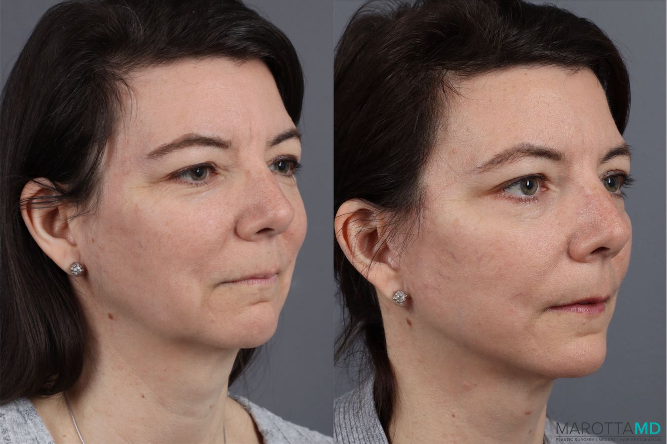 Before and after Mini Facelift case 13003 - Angle 2