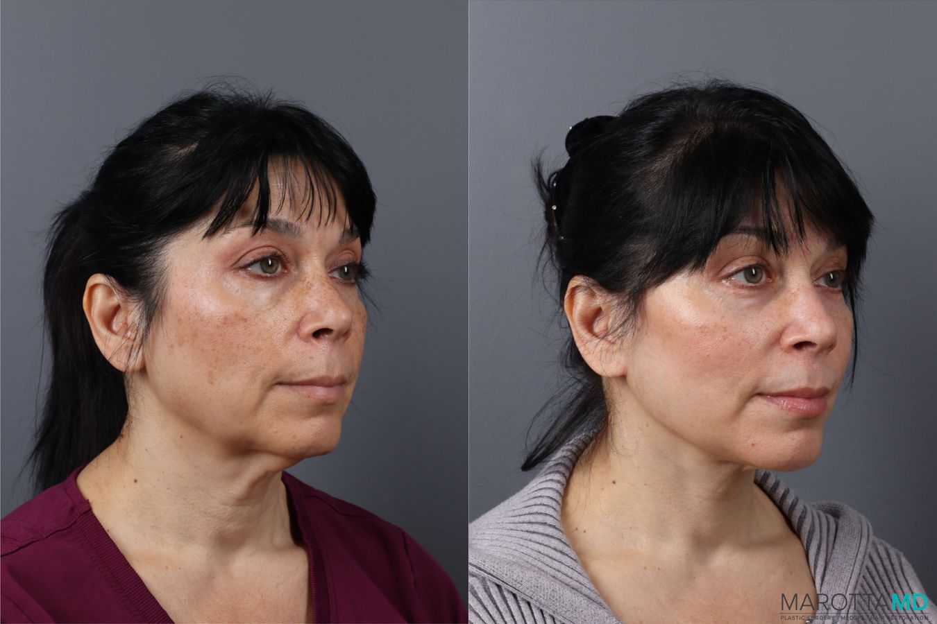 Before and after Laser Skin Resurfacing case 43162 - Angle 2