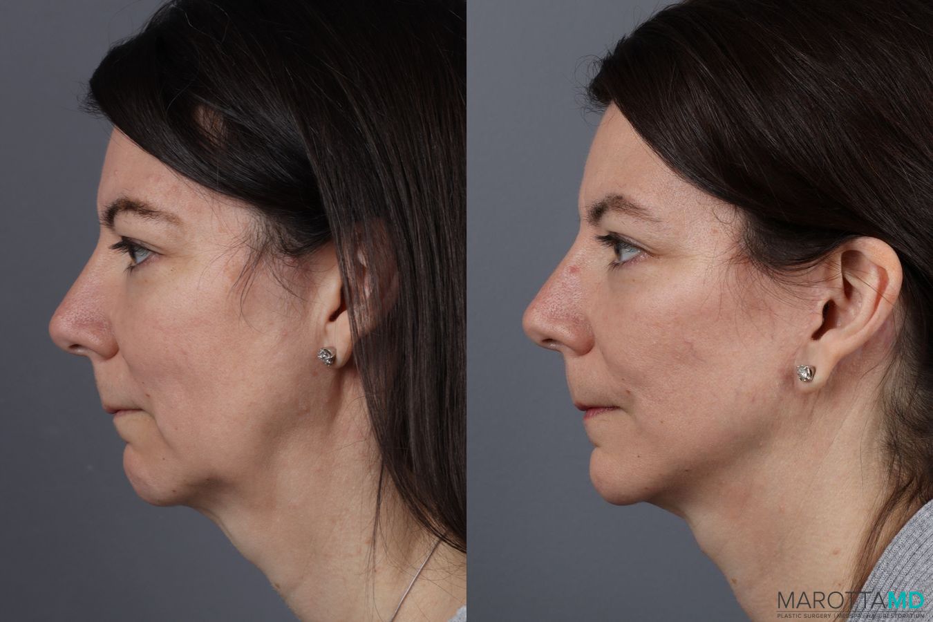 Before and after Mini Facelift case 13003 - Angle 5