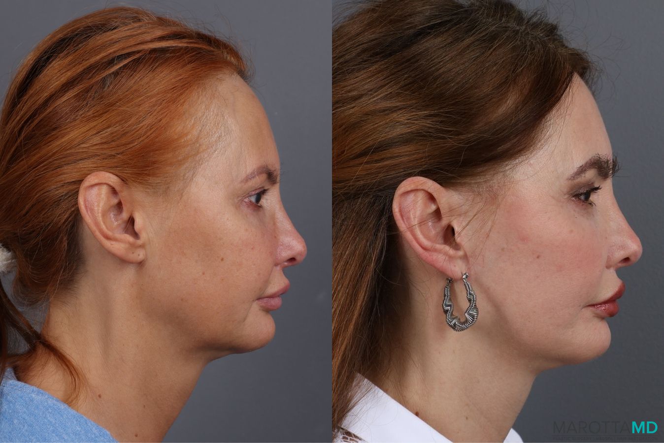 Before and after Mini Facelift case 7058 - Angle 3