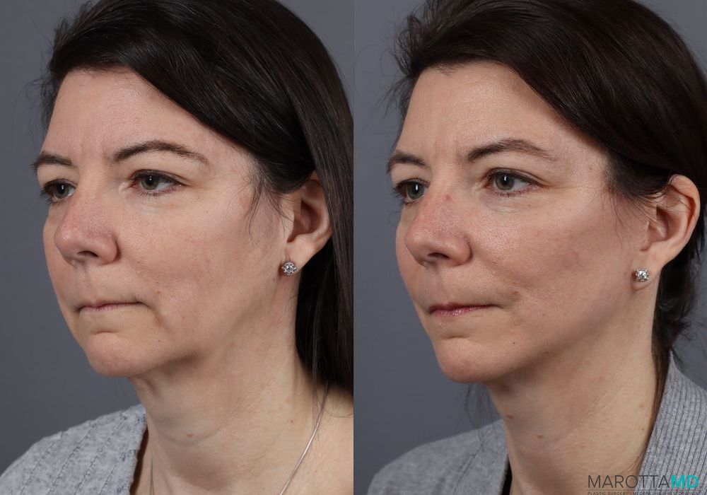 Mini Facelift - Thumbnail 3