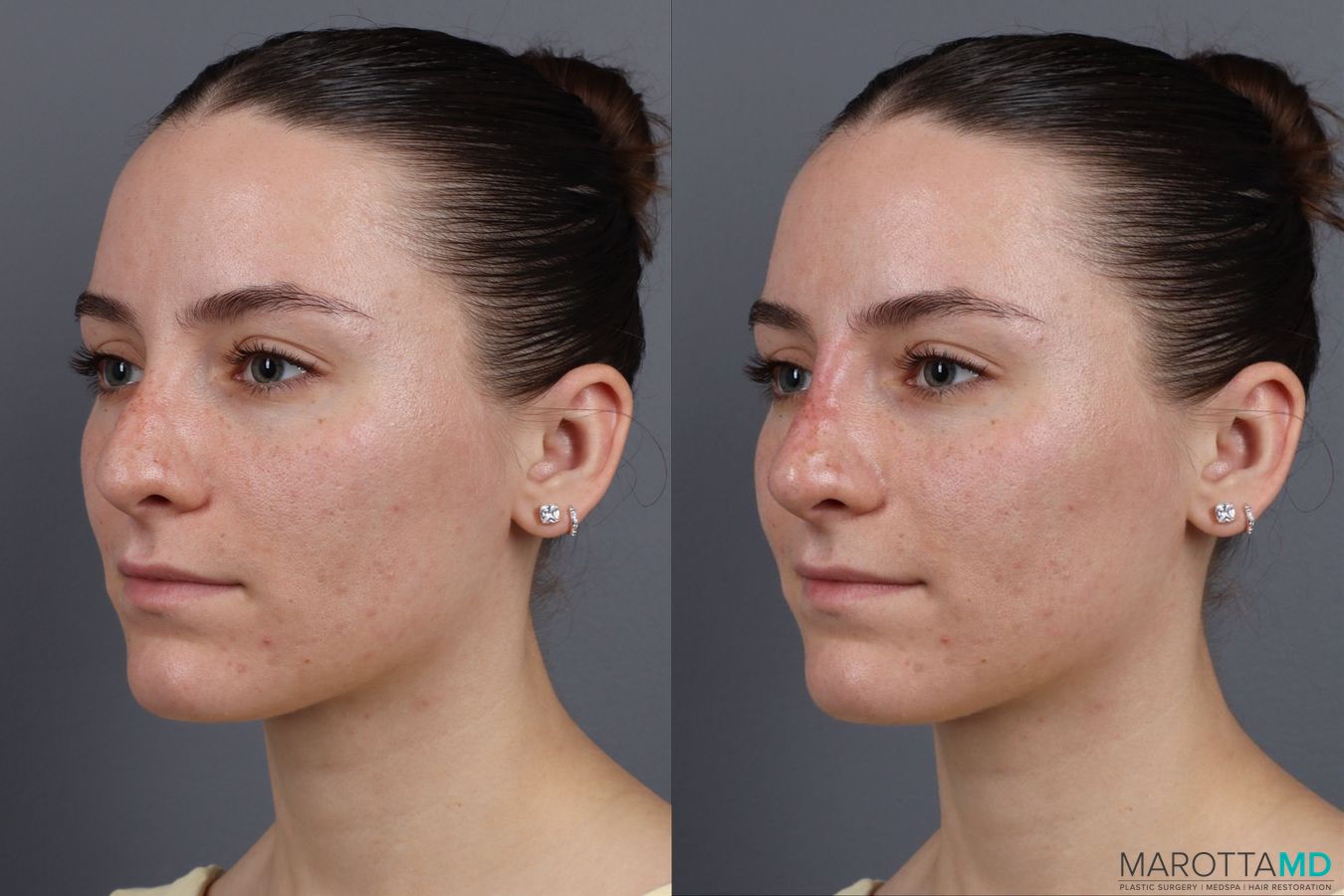 Before and after Non-Surgical Rhinoplasty case 16100