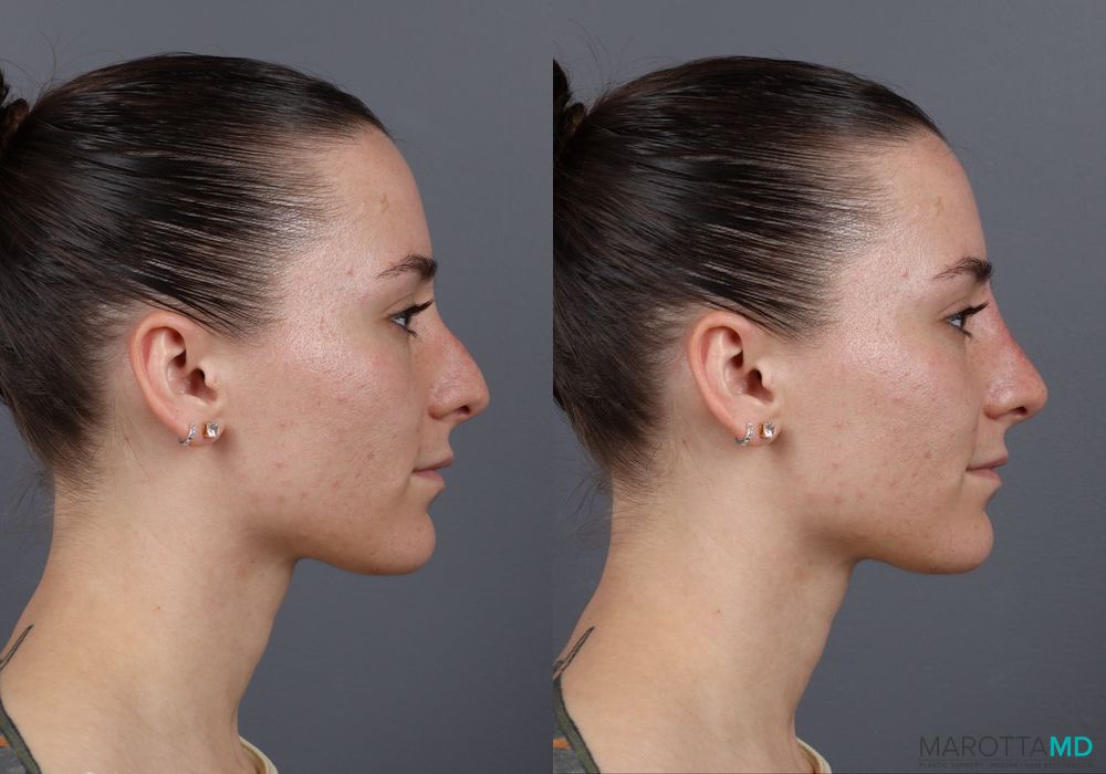 Before and after Non-Surgical Rhinoplasty case 16100 - Angle 4