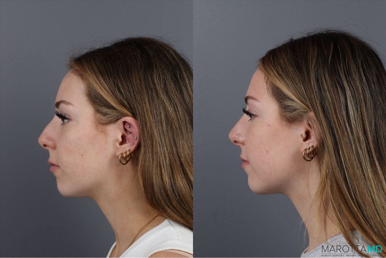 Before and after Non-Surgical Rhinoplasty case 41879 - Angle 4