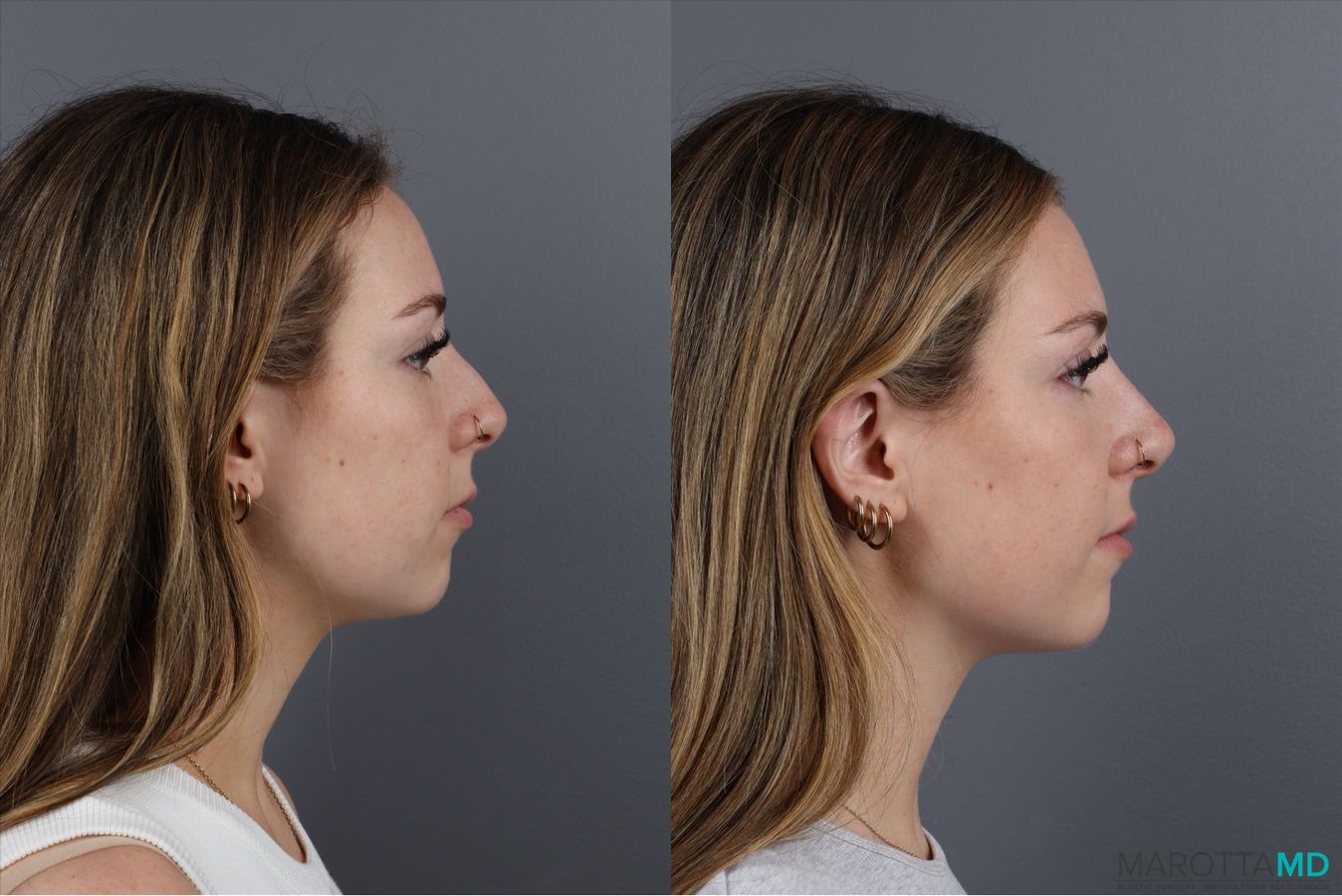 Before and after Non-Surgical Rhinoplasty case 41879 - Angle 3