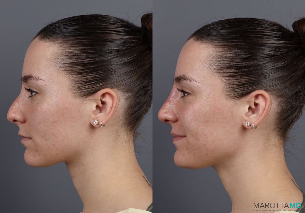 Before and after Non-Surgical Rhinoplasty case 16100 - Angle 2