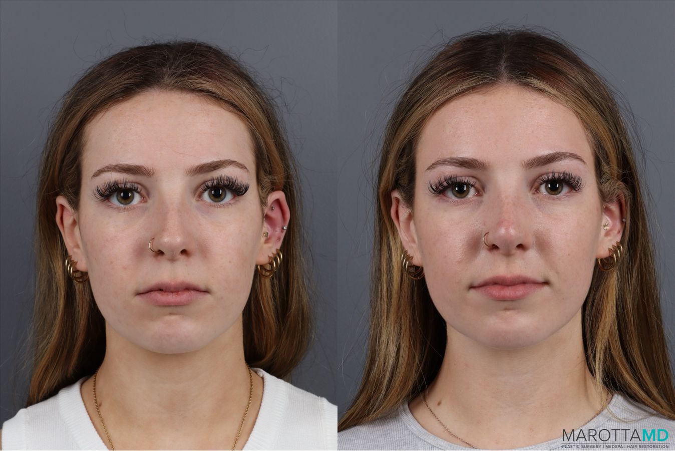 Before and after Non-Surgical Rhinoplasty case 41879