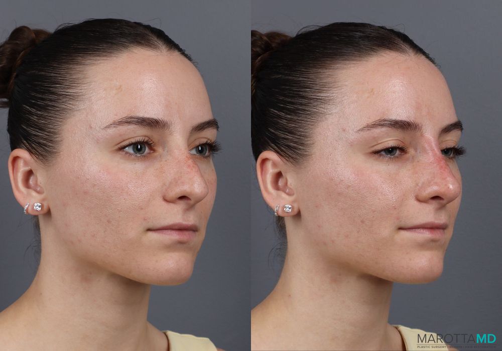 Before and after Non-Surgical Rhinoplasty case 16100 - Angle 3