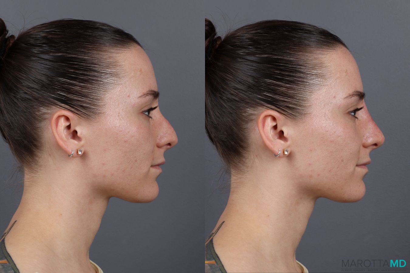 Before and after Non-Surgical Rhinoplasty case 16100 - Angle 4