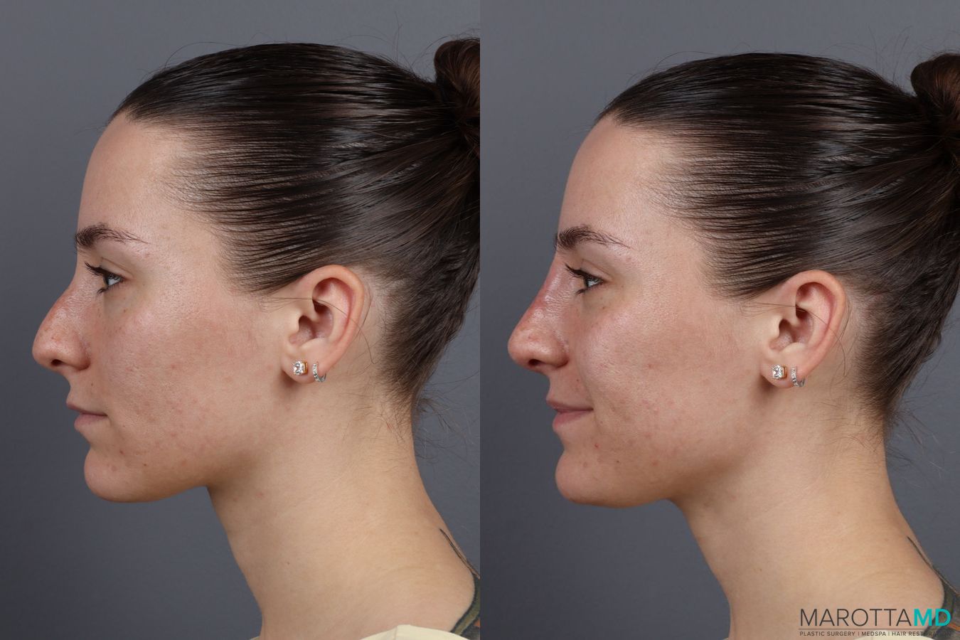 Before and after Non-Surgical Rhinoplasty case 16100 - Angle 2