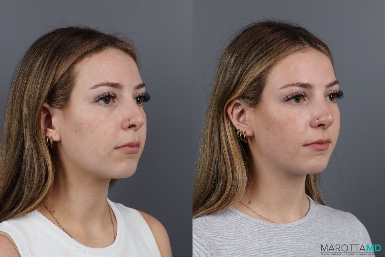 Before and after Non-Surgical Rhinoplasty case 41879 - Angle 2