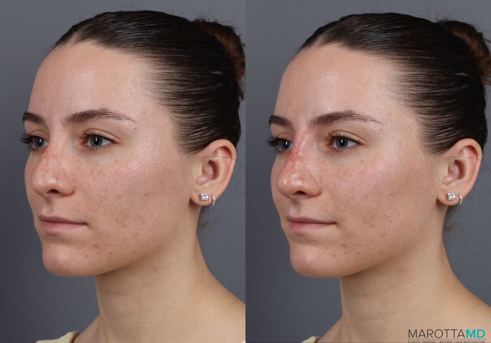 Non-Surgical Rhinoplasty - Thumbnail 4