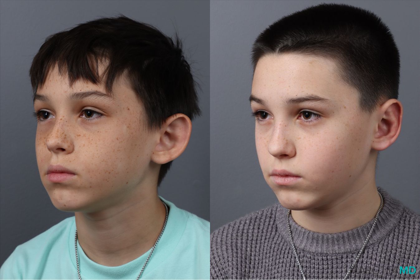 Before and after Otoplasty case 21380 - Angle 4