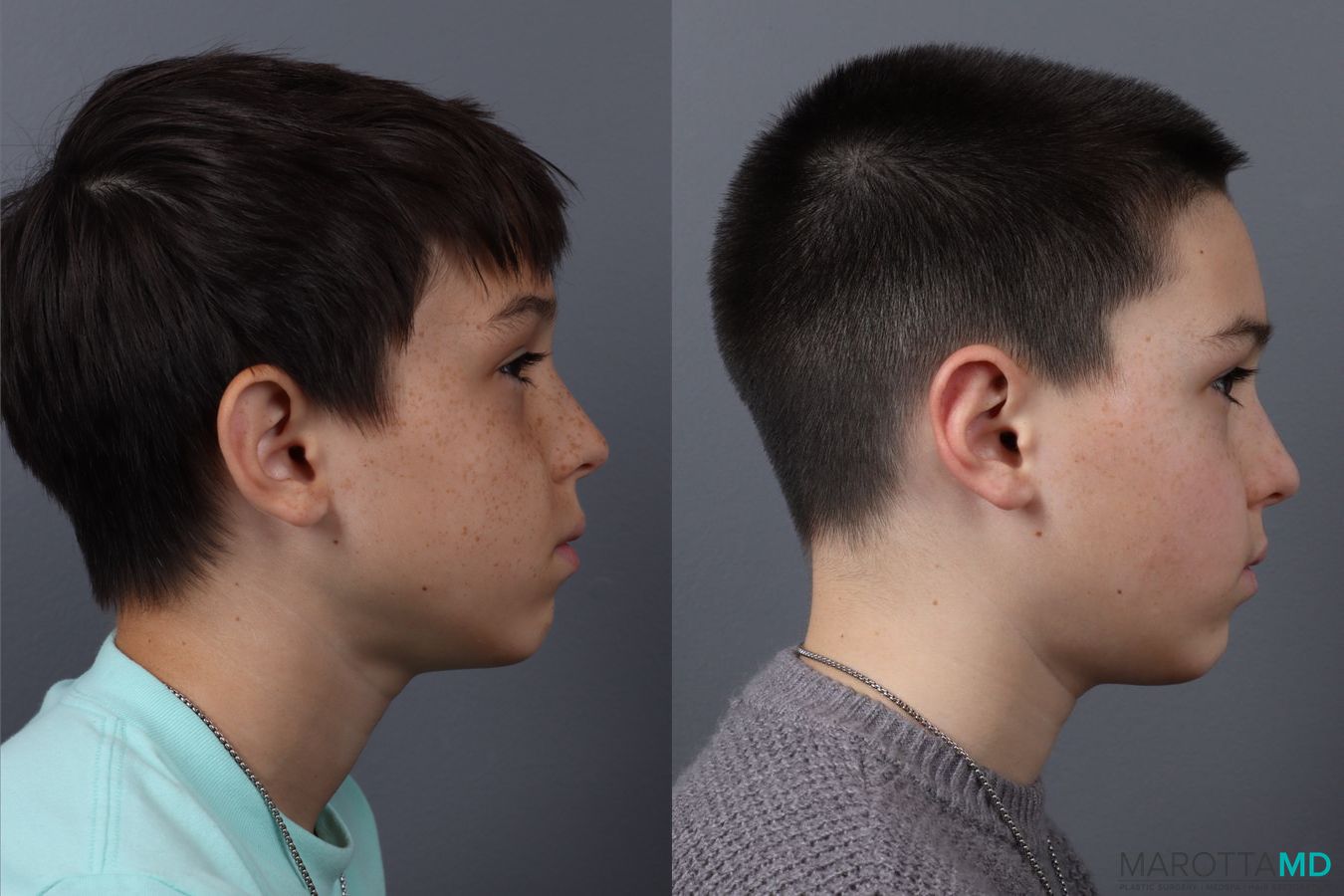 Before and after Otoplasty case 21380 - Angle 3